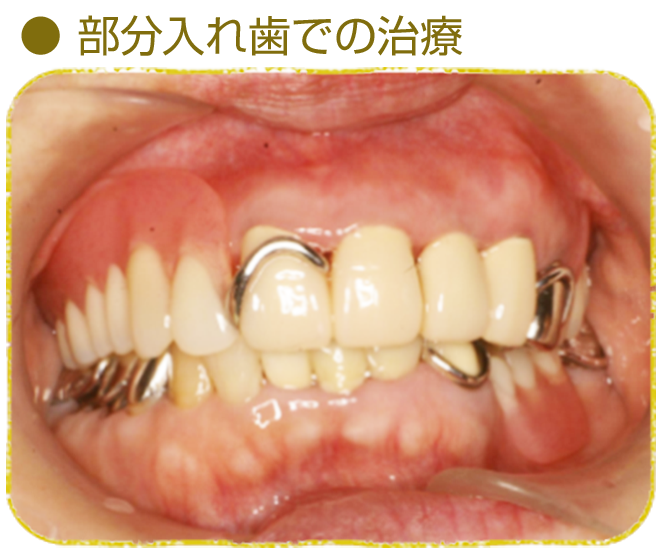 入れ歯（義歯）の治療