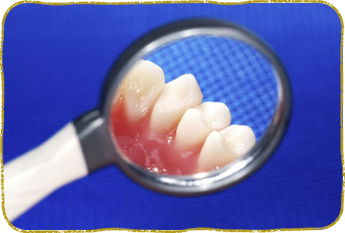 歯周病の現状