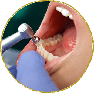 予防・クリーニング