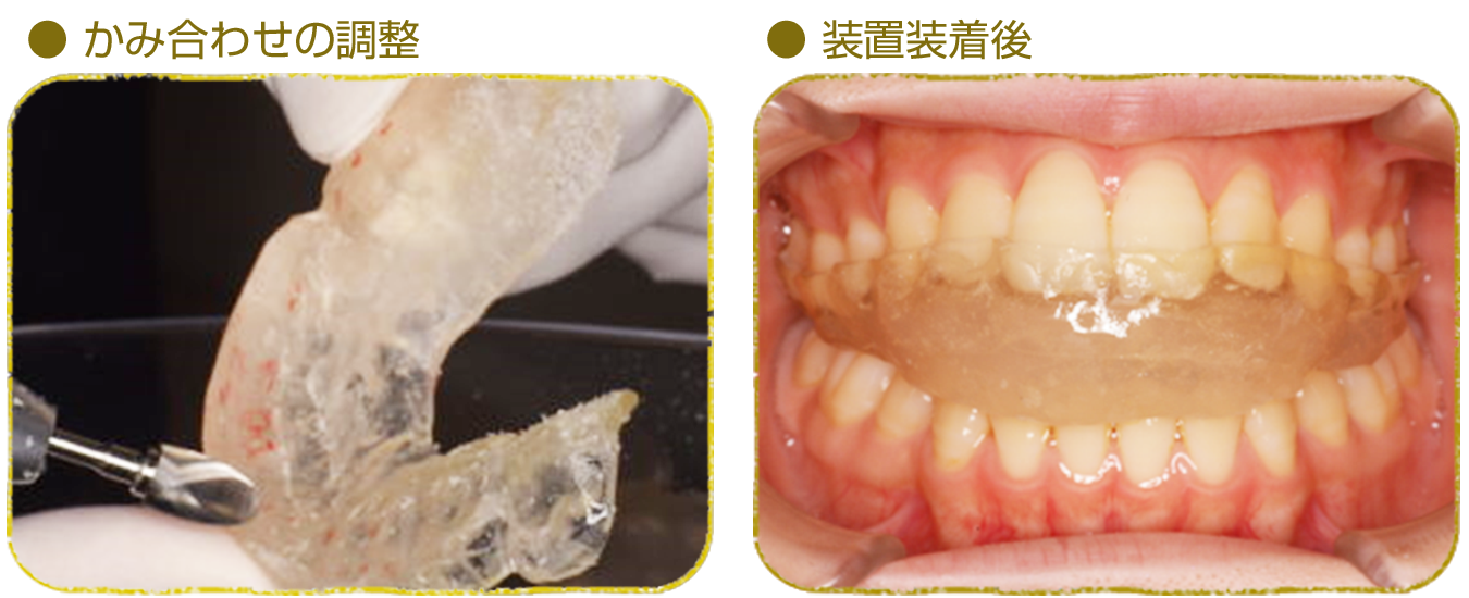 歯ぎしり・食いしばり