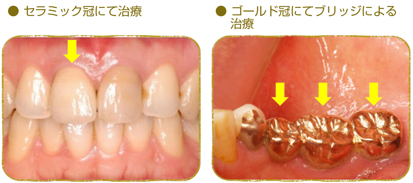 被せ物の治療