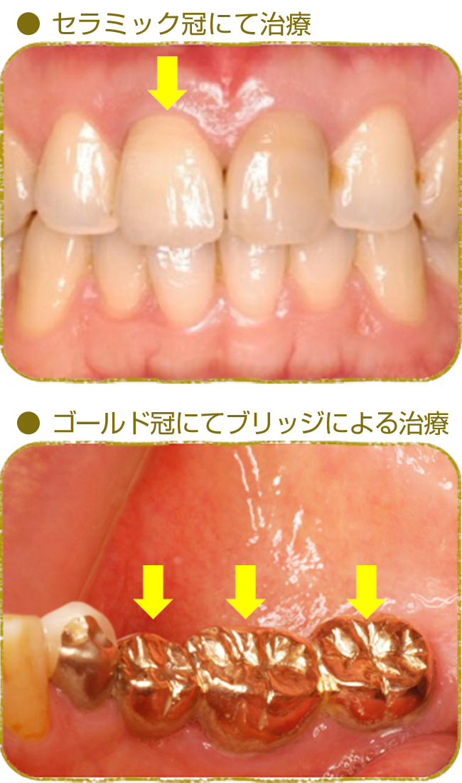 被せ物の治療